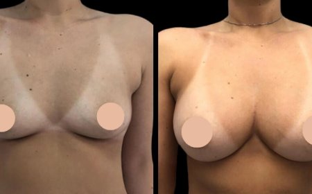 Transform Your Look: Best Breast Augmentation Surgeon in Dubai Speaks Out