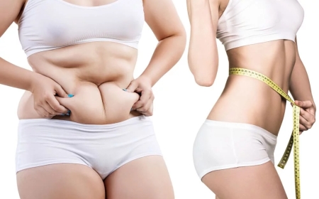 Tummy Tuck Dubai: Exploring the Role of Tummy Tuck in Mommy Makeovers