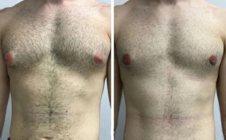 Expert Insights from the Best Doctors in Dubai on Treating Gynecomastia Safely