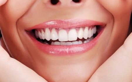 Transform Your Smile with Veneers in Dubai: What to Expect