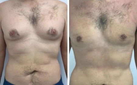 Post-Surgery Tips for a Healthy Lifestyle After Gynecomastia in Dubai