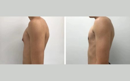 Why You Need the Best Doctors in Dubai for Gynecomastia