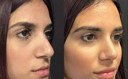 Why ENT Specialists Recommend Nose Deviated Septum Surgery in Dubai