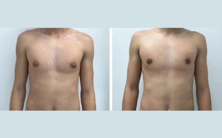 Why the Best Gynecomastia Surgeons in Dubai Provide Personalized and Compassionate Care
