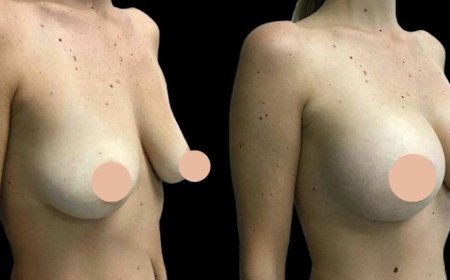 The Role of 3D Imaging in Breast Augmentation by the Best Doctors in Dubai