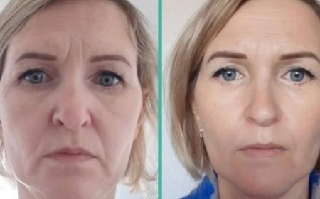 Youthful Radiance The Power of 7D HIFU Facial Treatment