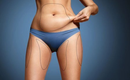 Tummy Tuck Dubai: A Complete Guide to Contouring Your Waistline