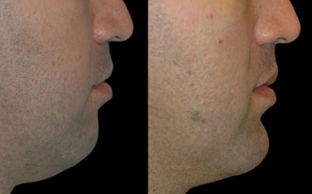 How the Best Doctors in Dubai Customize Chin Fillers for Each Patient