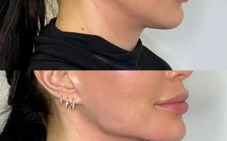 Jawline Contouring with Fillers: Best Doctors in Dubai to Trust
