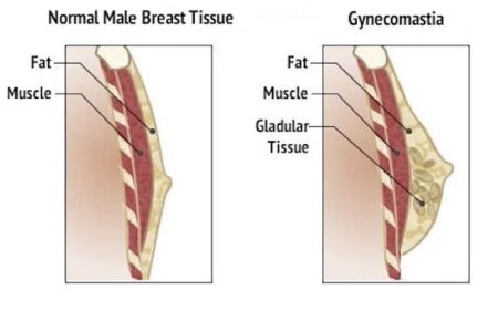 Benefits of Choosing Man Boobs Surgery in Islamabad for a Confident Look