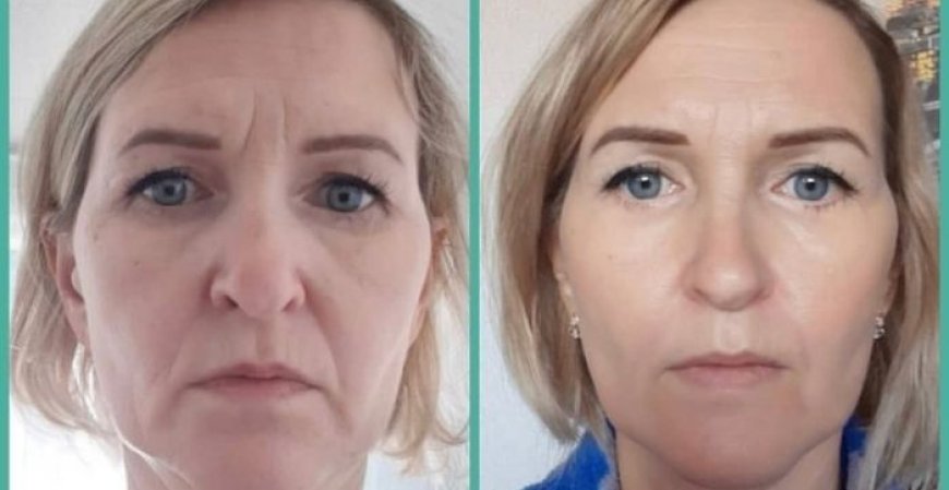 Youthful Radiance The Power of 7D HIFU Facial Treatment